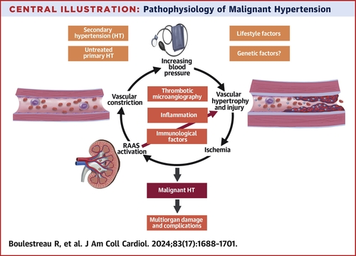 Malignant Hypertension:A Systemic Cardiovascular Disease: JACC Review Topic of the Week
